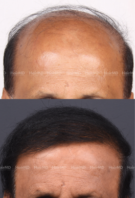 56-years old male Hair Transplant Results 2-Year 5000-6000 Grafts HairMD Pune