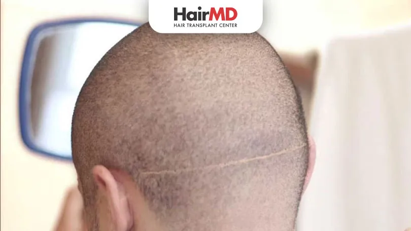 Are Hair Transplant Scar Visible HairMD Pune
