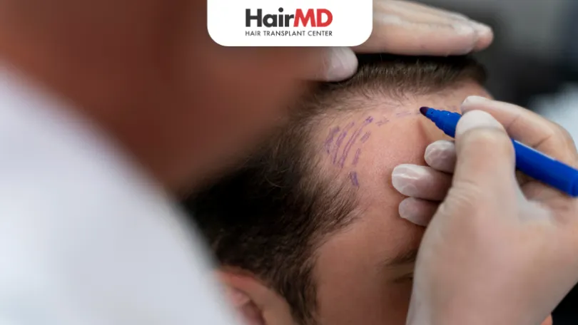 hair transplant without shaving head