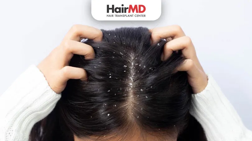 How to get rid of dry scalp flakes due to minoxidil?