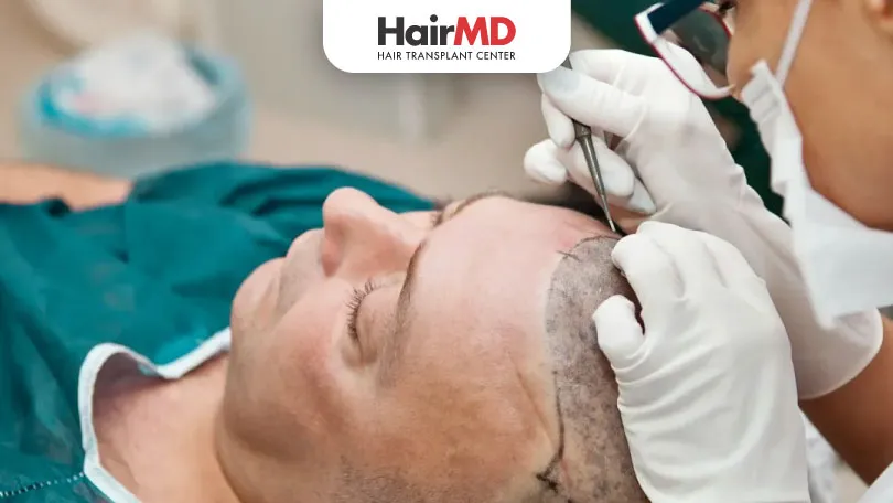 Is Hair Transplant Permanent HairMD Pune