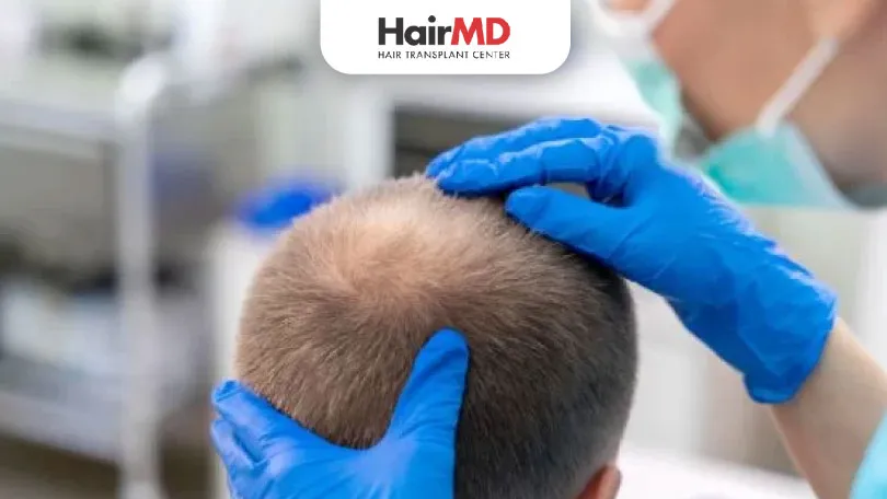 Is Synthetic Hair Transplant Permanent?