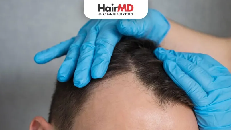 What is the Minimum Age for Hair Transplant HairMD Pune