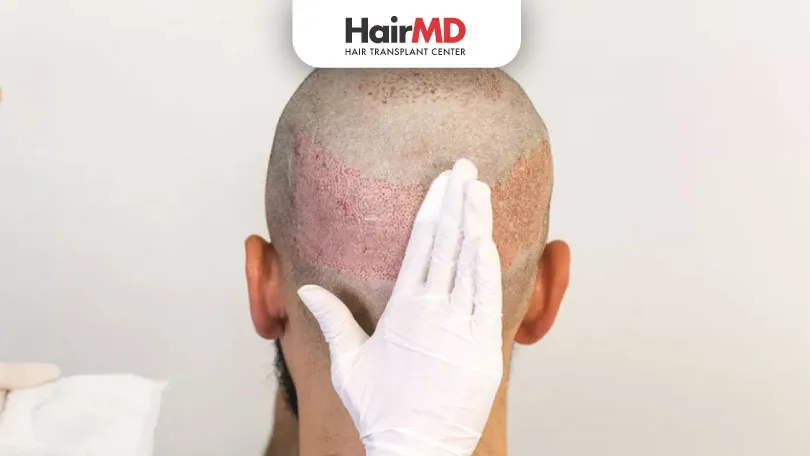 medication after hair transplant